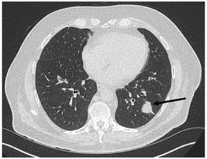Tumoren van longkankerpatiënt krimpen na het innemen van CBD-olie. Deze verbazingwekkende scans laten het zien