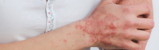 Psoriasis… 1 bewezen methode om ervan te genezen!