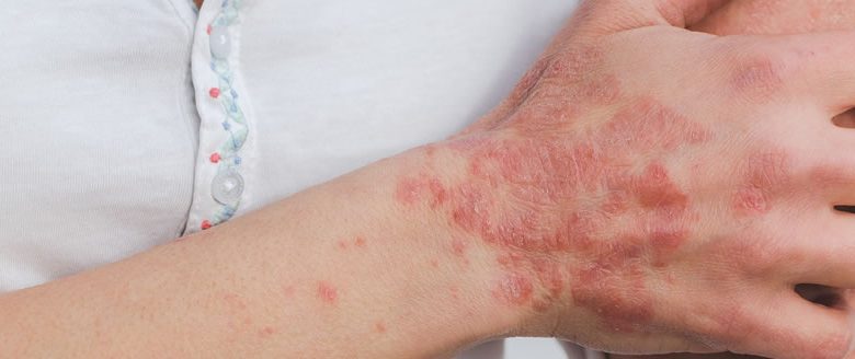 psoriasis