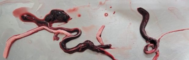 Einbalsamierer entdecken seltsame, gummiartige Ausscheidungen in den Körpern von Covid-geimpften Leichen