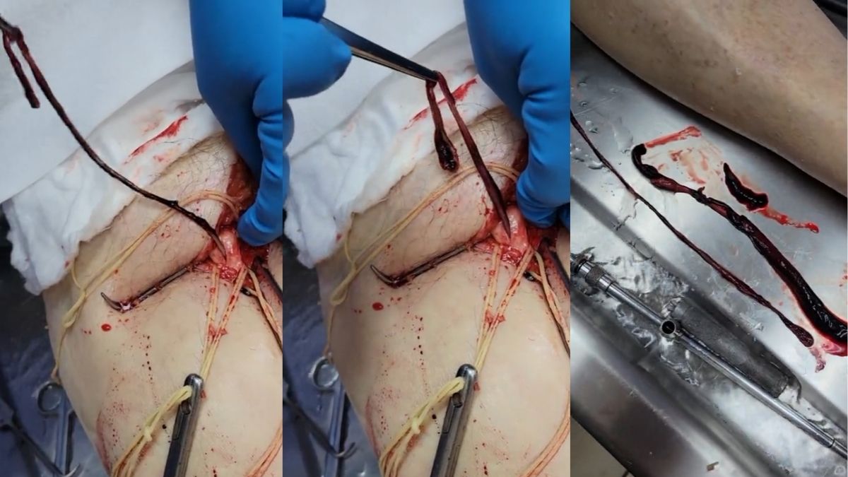 Ongelofelijke bloedproppen uit lichamen van gevaccineerden gehaald: ‘Dit is niet normaal’