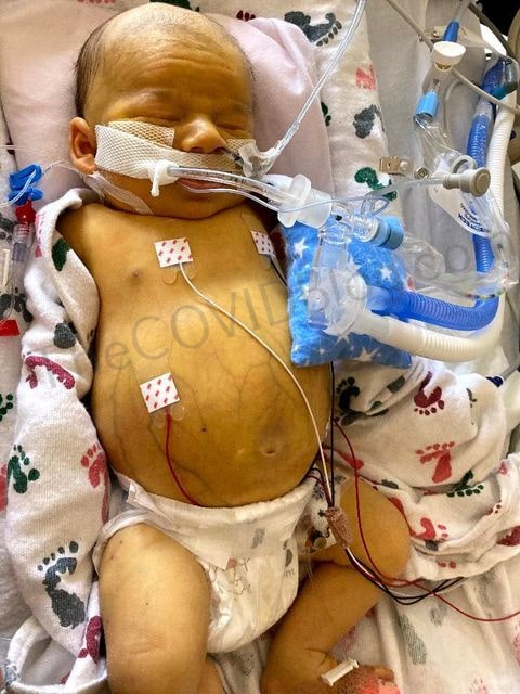 Tragisch: Baby Alex overlijdt aan 'enorme' bloedprop na bloedtransfusie 3 alex