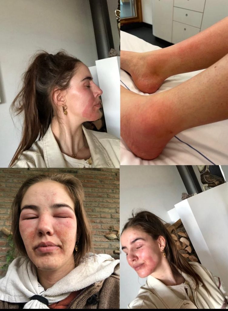 Anne Merel kreeg ernstige aandoeningen door covidprik, maar volgens artsen leed ze aan HALLUCINATIES 2 kr