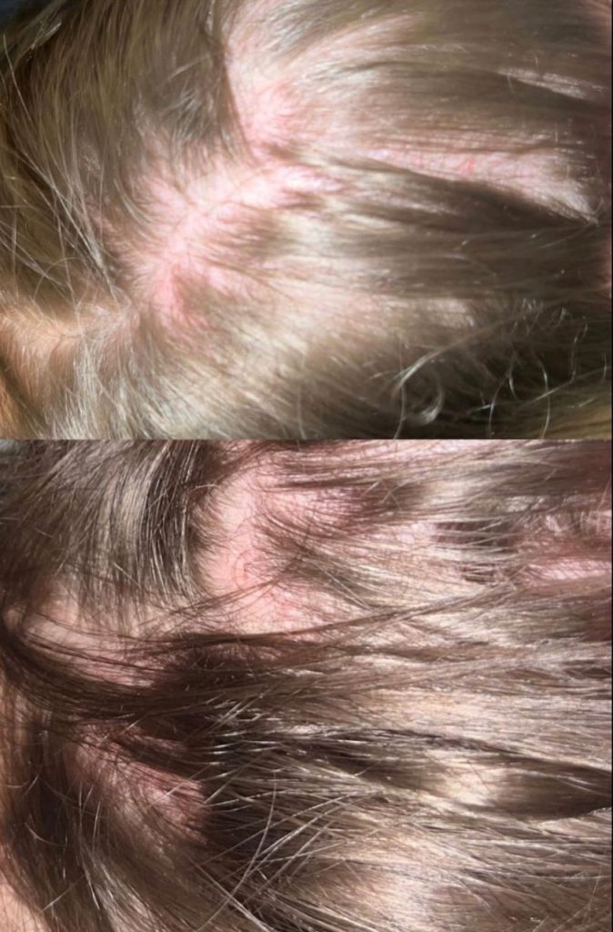 Anne Merel kreeg ernstige aandoeningen door covidprik, maar volgens artsen leed ze aan HALLUCINATIES 3 kr