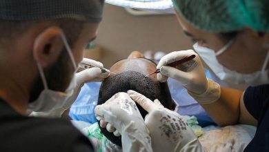 haartransplantatie2