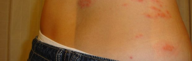 Explosie van gordelroos in Nederland: ‘Heb nooit zoveel gezien als de laatste jaren’