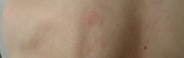 Hoe je allergieën kunt uitschakelen zonder medicijnen