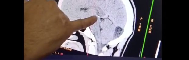 Arts toont ons de neurologische schade die het COVID-19-vaccin veroorzaakt